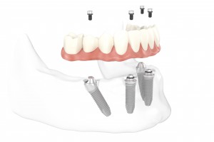 Workflow_All-on-4_step09_300dpi_WB